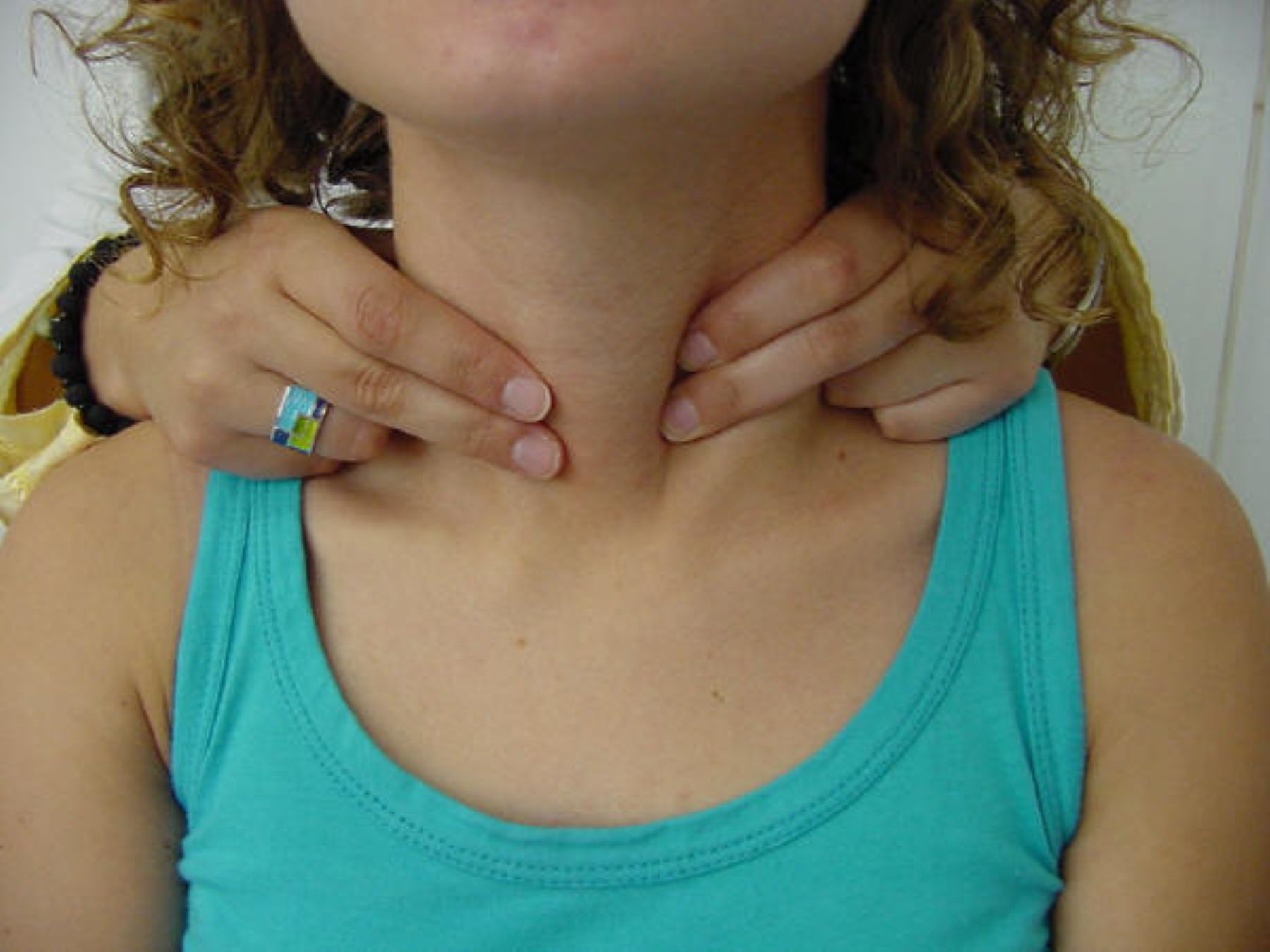 фото увеличенной щитовидной железы у женщин