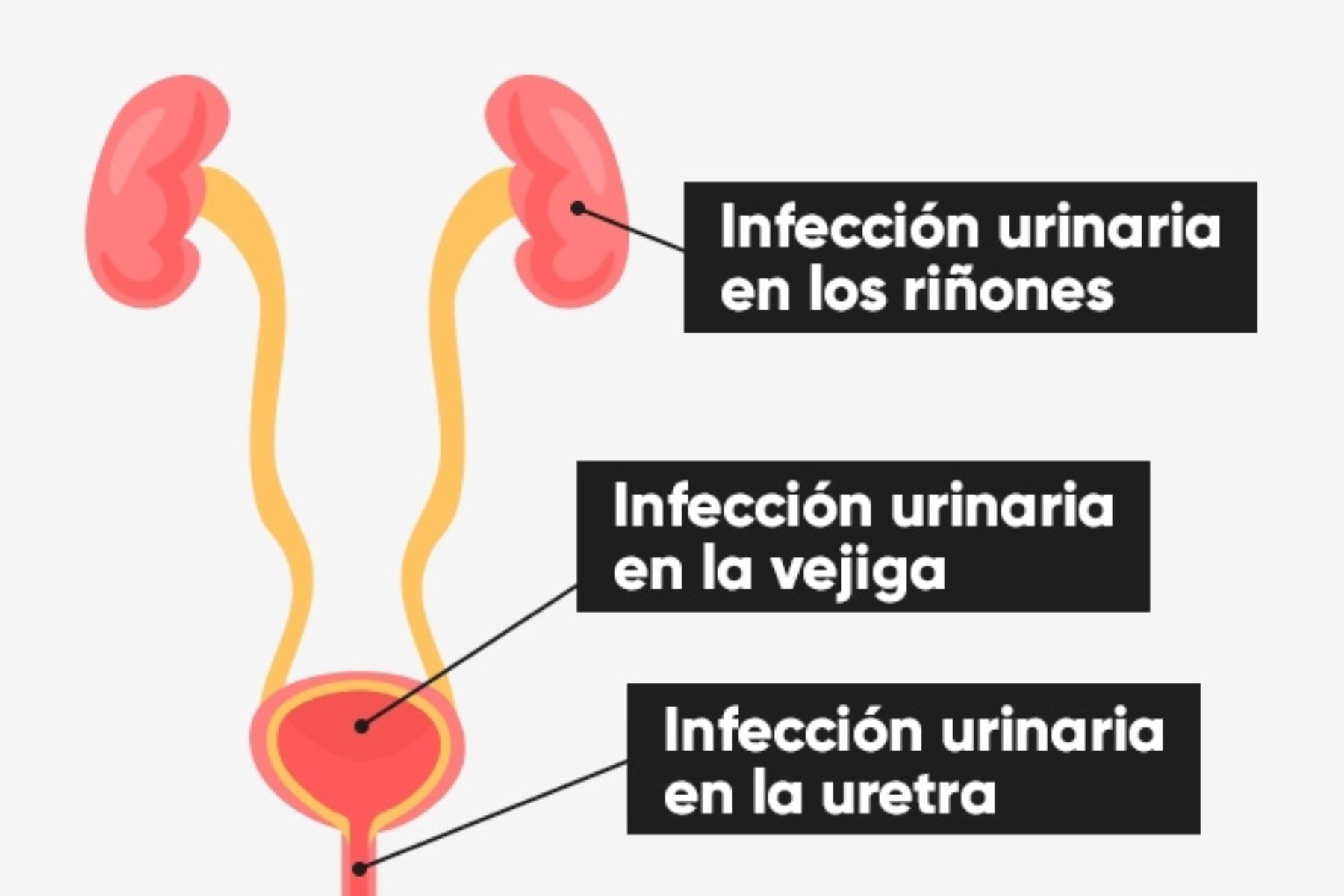 Infeccion de orina y cetosis