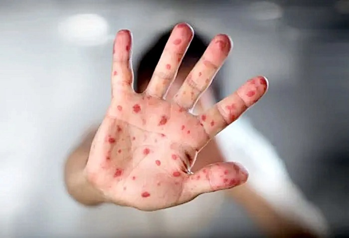 Brote de virus mano, pie y boca en Lambayeque