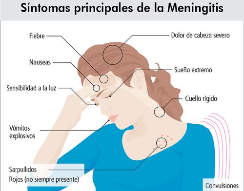 Síntomas de la meningitis. Foto: ANDINA/Difusión.