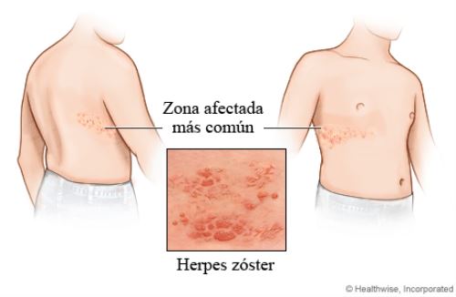 Cualquier persona que haya sufrido varicela puede desarrollar herpes zóster, incluso niños, pero el riesgo de desarrollarla se incrementa con la edad.