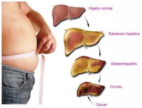 Llevar una vida sedentaria y presentar altos niveles de triglicéridos, colesterol y diabetes son en muchas ocasiones indicadores de que los pacientes puedan presentar también un hígado graso, señalaron especialistas de EsSalud.