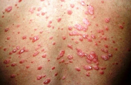 En Perú cerca de medio millón de personas padecen de psoriasis. Foto: ANDINA/Difusión.