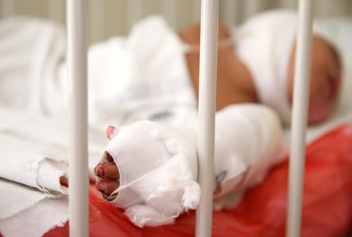 Brindarán atención médica gratuita a niños quemados de la región Huánuco. ANDINA/Melina Mejía