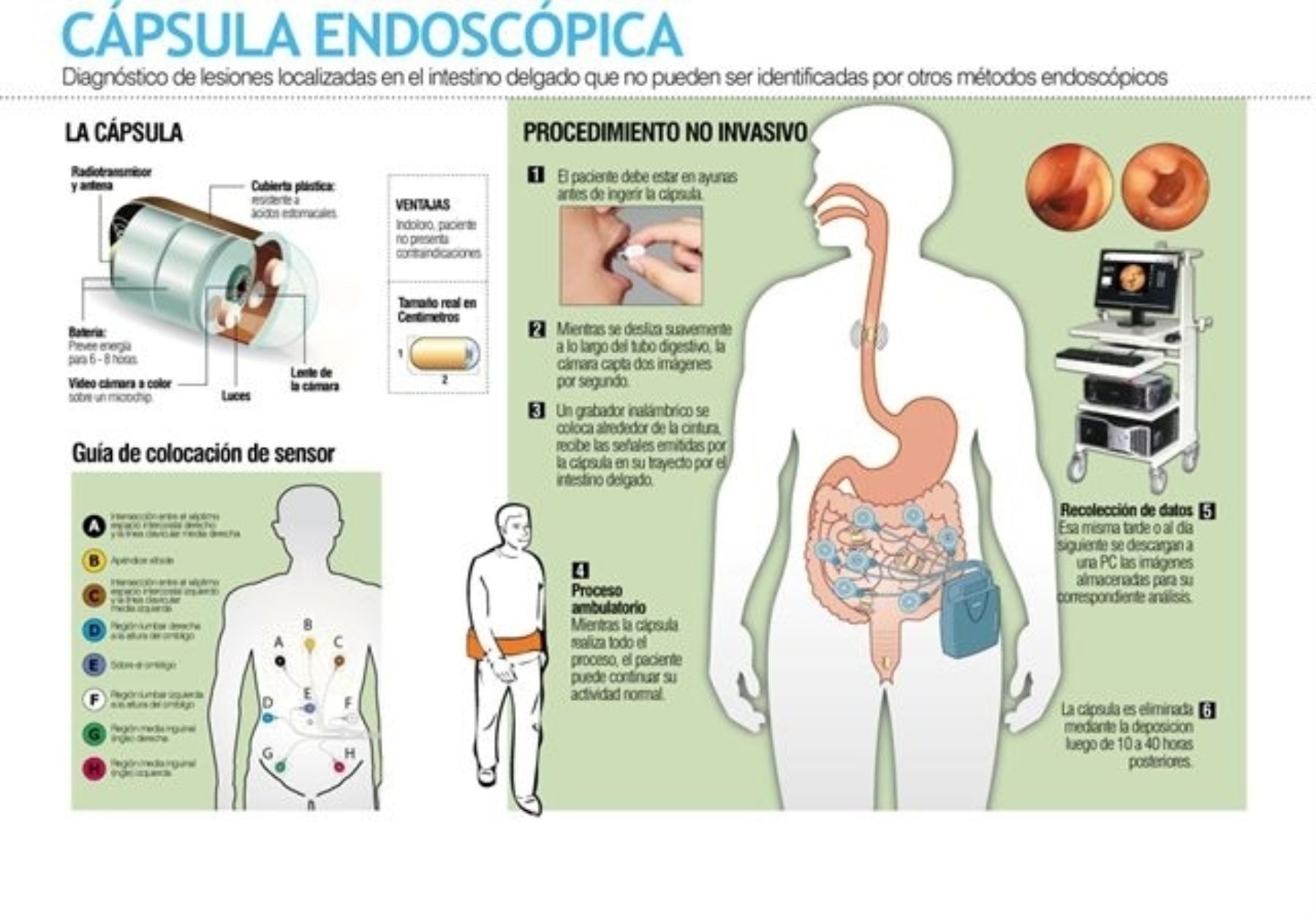 Infografía que explica el funcionamiento de la "cápsula endoscópica" que utiliza con éxito EsSalud para detectar y tratar enfermedades en el sistema digestivo, sobre todo en el intestino delgado. Foto: EsSalud