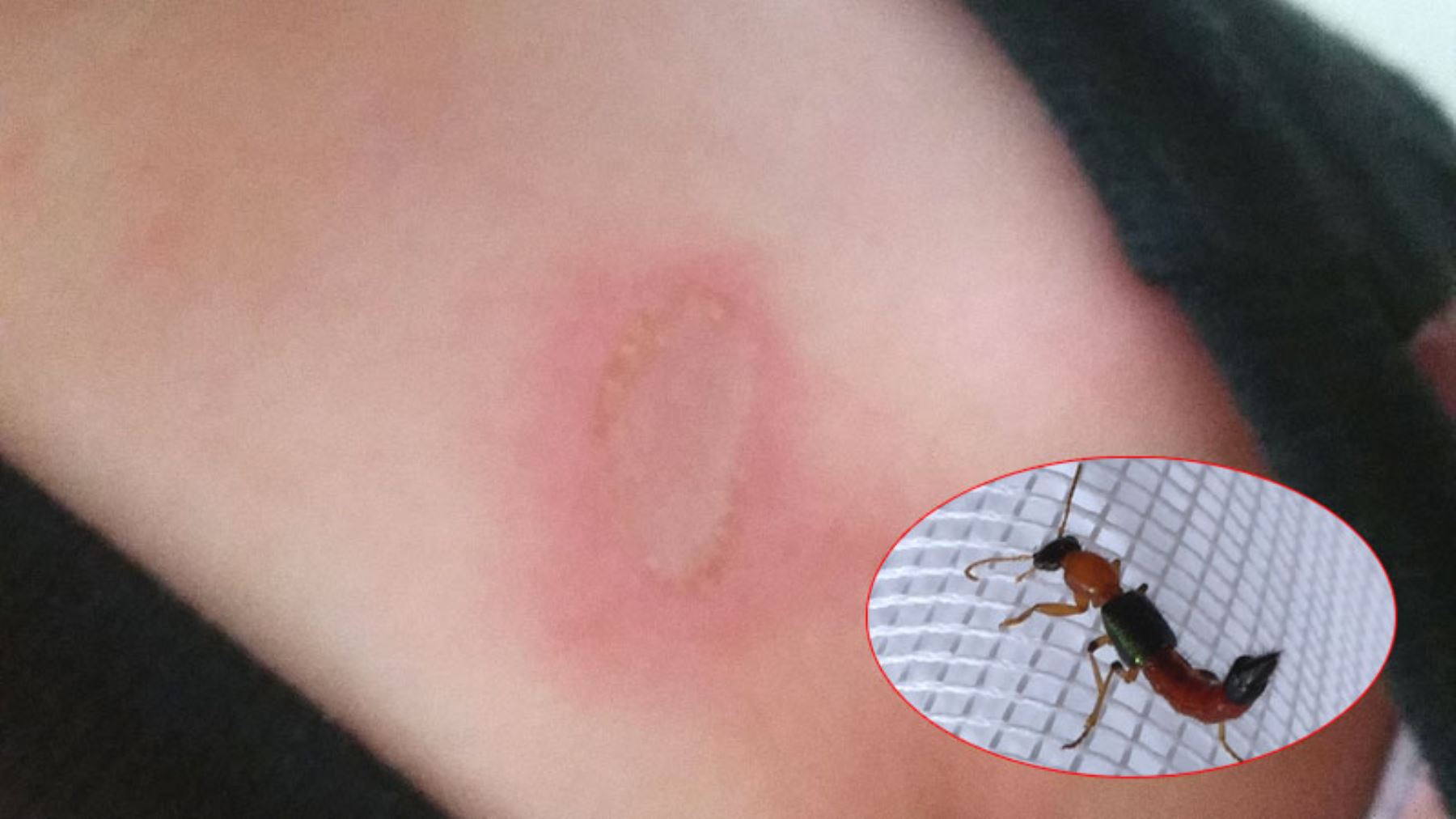 Picadura de mosquito aumenta en verano. Foto: Difusión