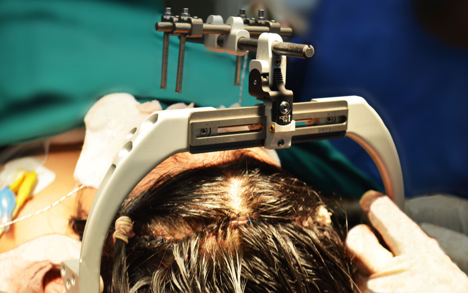 Una operación de alta complejidad permitió corregir malformación en menor víctima de Síndrome de Crouzon. Foto: Andina/Difusión
