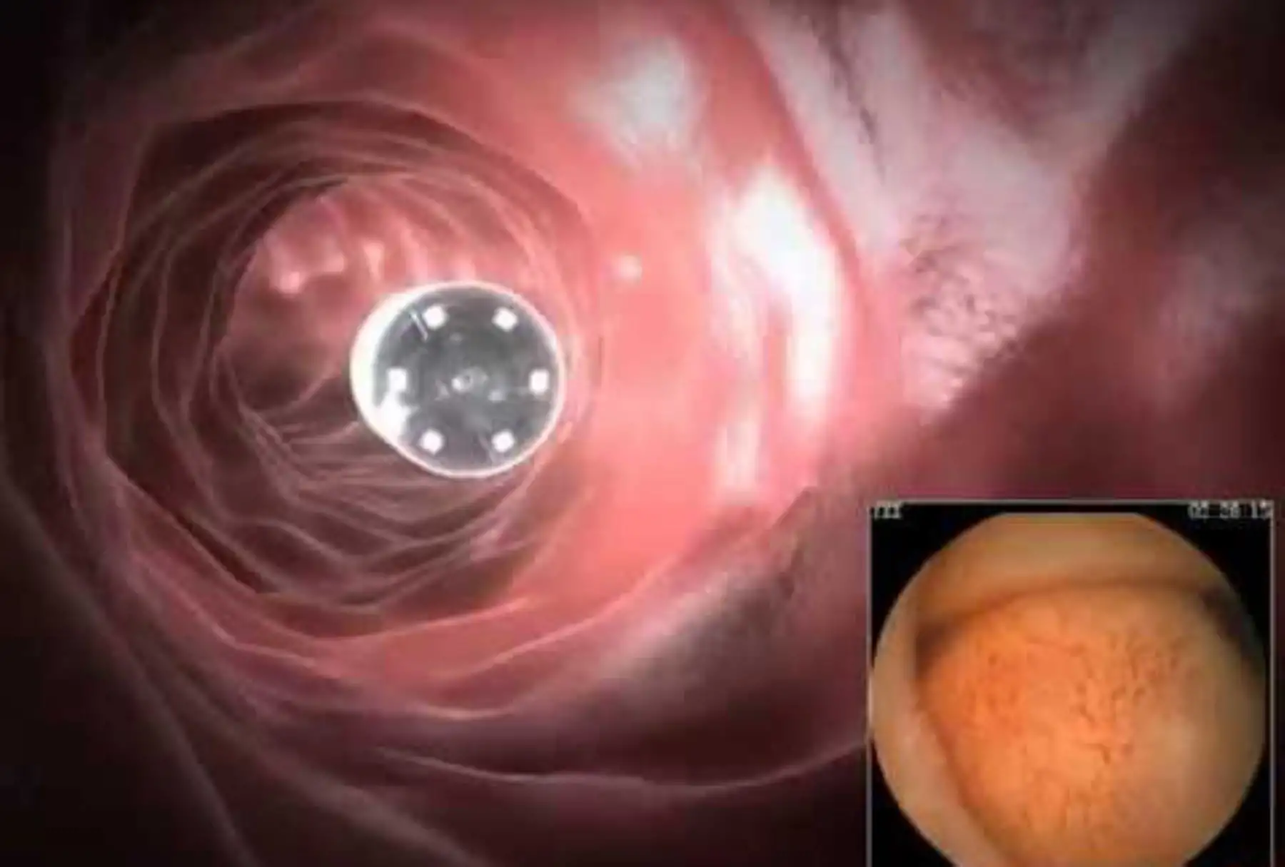 cáncer de intestino delgado, cápsula endoscópica, essalud