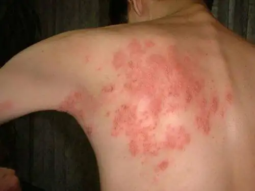 Herpes zóster afecta a adultos mayores ansiosos. Foto: Difusión