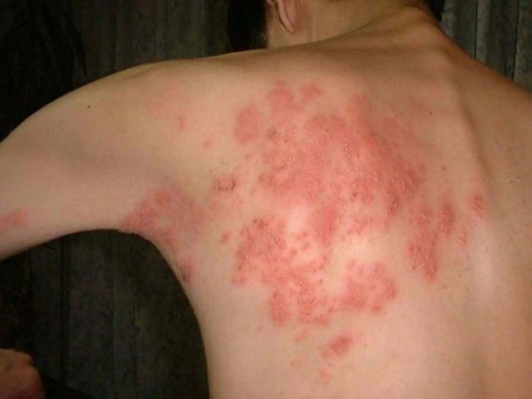 Herpes zóster afecta a adultos mayores ansiosos. Foto: Difusión