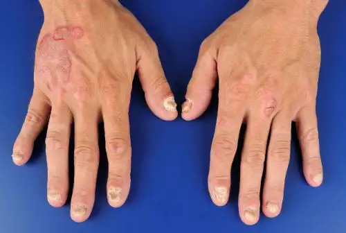 Artritis psoriásica. Foto:Internet/Medios