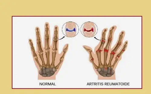 Expecialista recomienda evitar alimentos que provocan inflamaciones en las articulaciones a pacientes con artritis reumatoide.. Foto: Internet