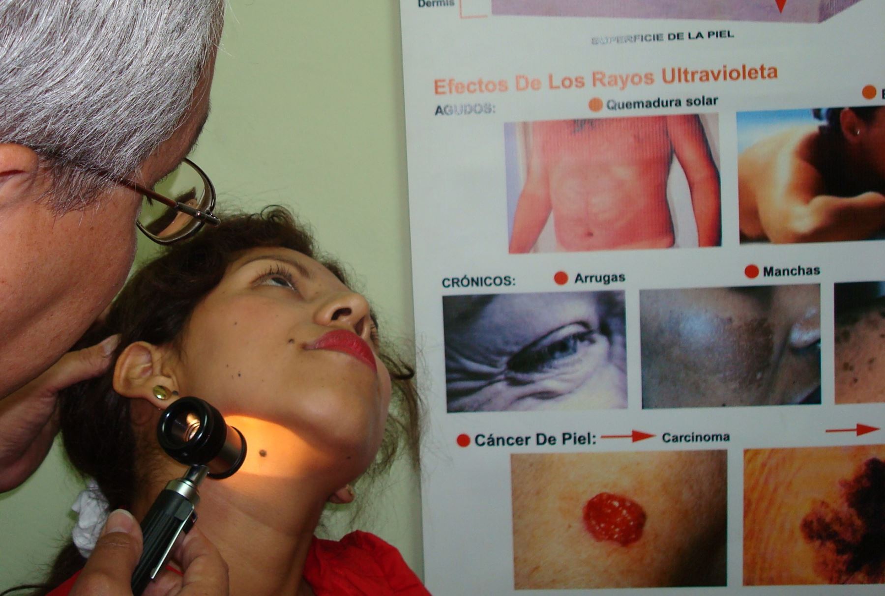 Es necesario consultar a un especialista cuando se tiene manchas o lunares para descartar el cáncer. Foto: ANDINA/Difusión