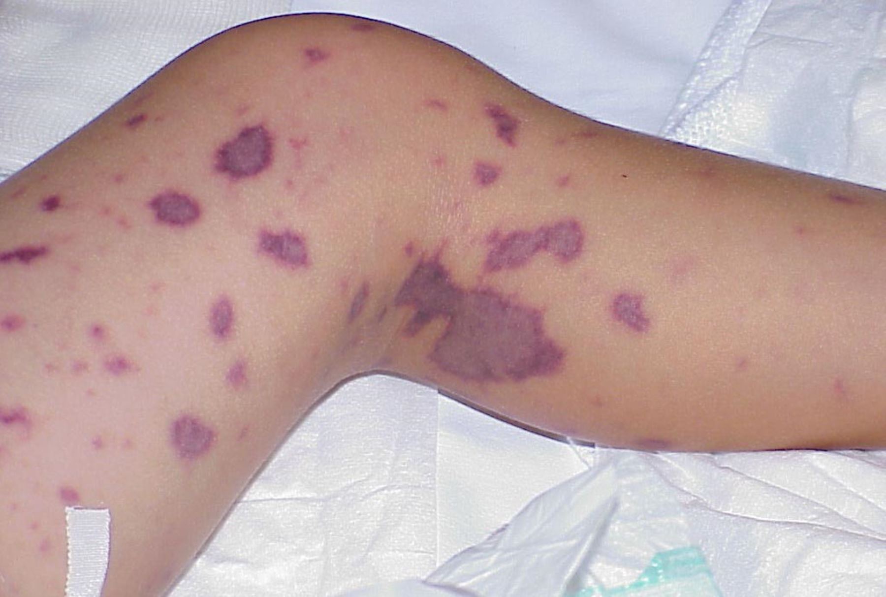 Erupciones en la piel es uno de los síntomas de este mal. Foto: Difusión