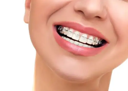 Existen "brackets" que incluso son trasparentes.