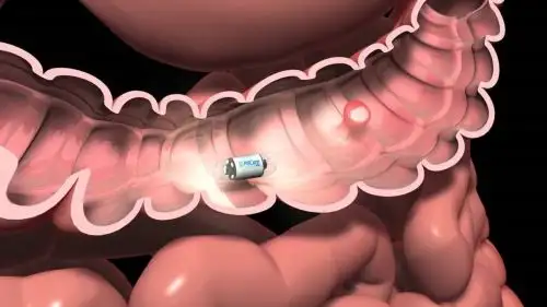Cáncer de colon y recto deben detectarse a tiempo. Foto: ANDINA/Difusión
