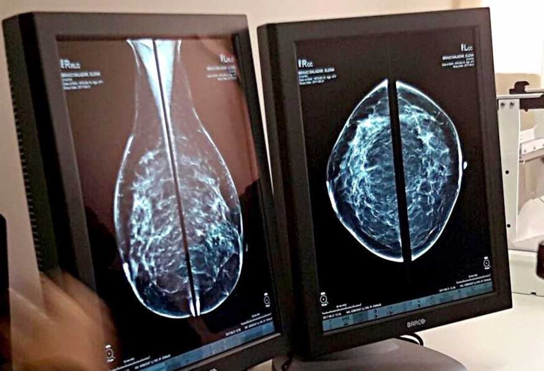 Las regiones de Junín y Puno lideran el acceso a las telemamografías para el diagnóstico oportuno del cáncer de mama, servicio del Ministerio de Salud (Minsa) que registra hasta ahora 1,056 atenciones a igual número de pacientes mujeres a escala nacional.