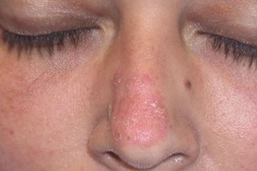 Síntoma de lupus eritomatoso. Foto: Andina/Difusión