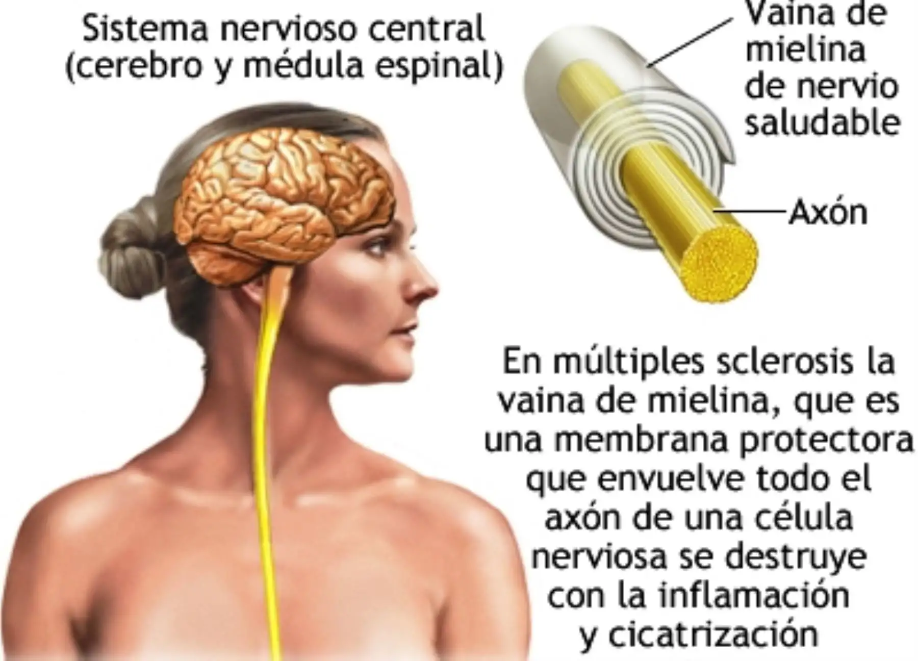 Siete de cada 100 mil peruanos sufren de esclerosis múltiple. Foto: ANDINA/Difusión.