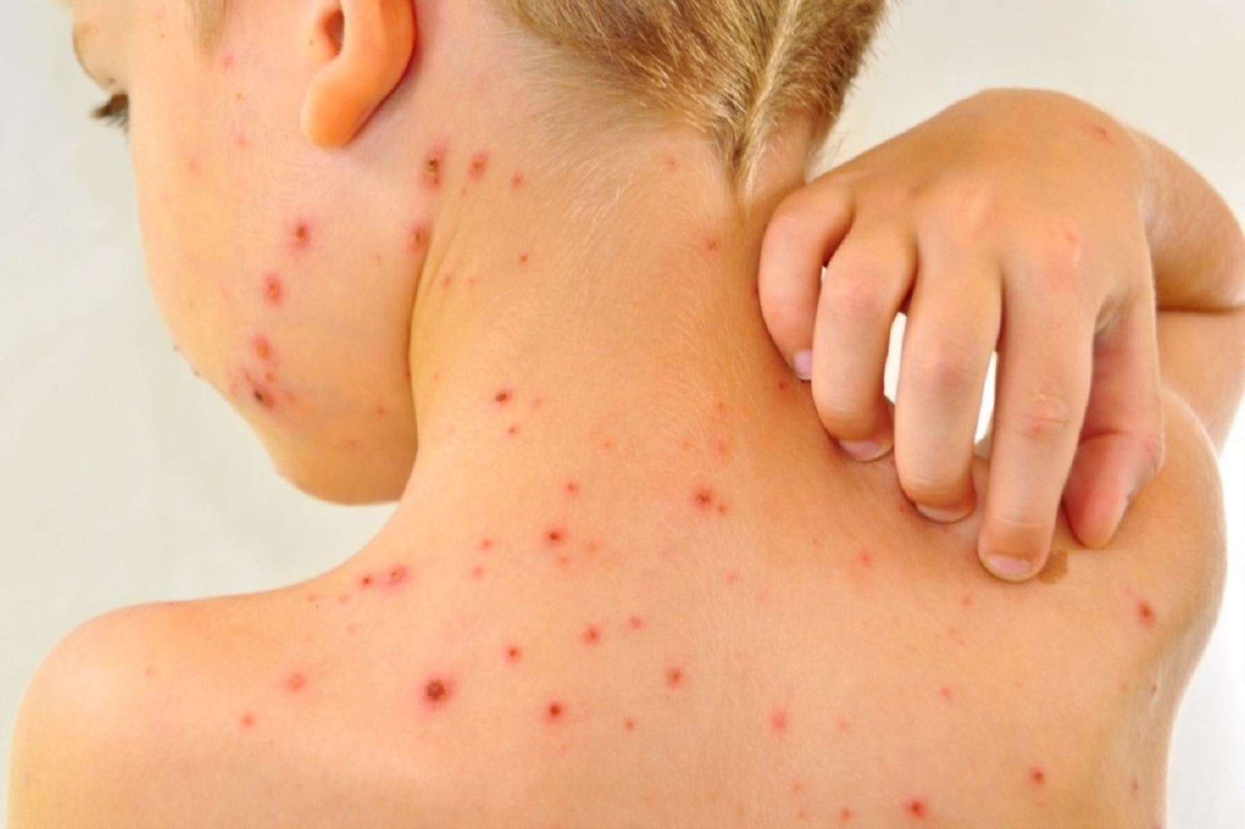 Cuatro razones por las que debes vacunar a tu hijo contra la varicela. Foto: ANDINA/Difusión.