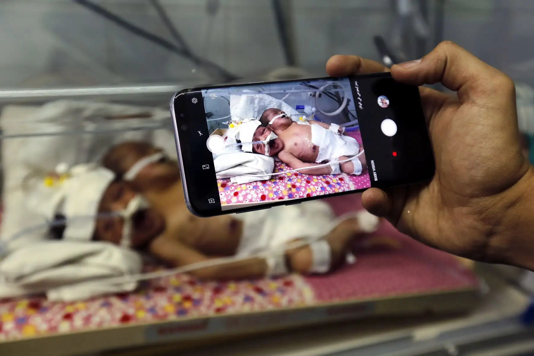 Un médico toma fotos de los hermanos siameses Abdul-Khaliq (dcha) y Abdul-Rahim (izq) en su incubadora de la UCI neonatal del hospital Al Thawra este domingo en San· (Yemen). Foto: EFE