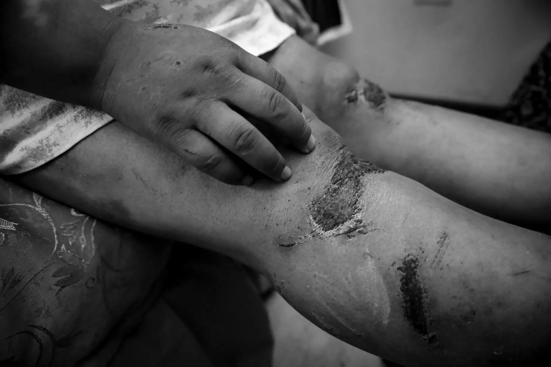Eliana Sucari sufrió heridas en varias partes del cuerpo.  Foto: ANDINA/Nathalie Sayago