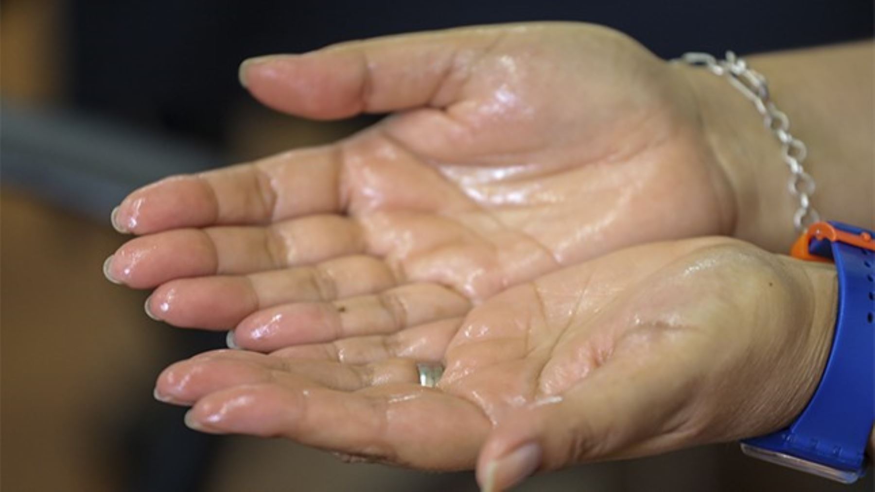 La excesiva sudoración de manos está relacionada a sudoración de cara y otras partes del cuerpo.