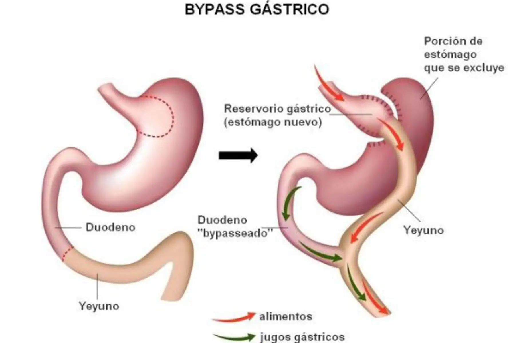 Bypass gástrico. Foto: Internet/Medios