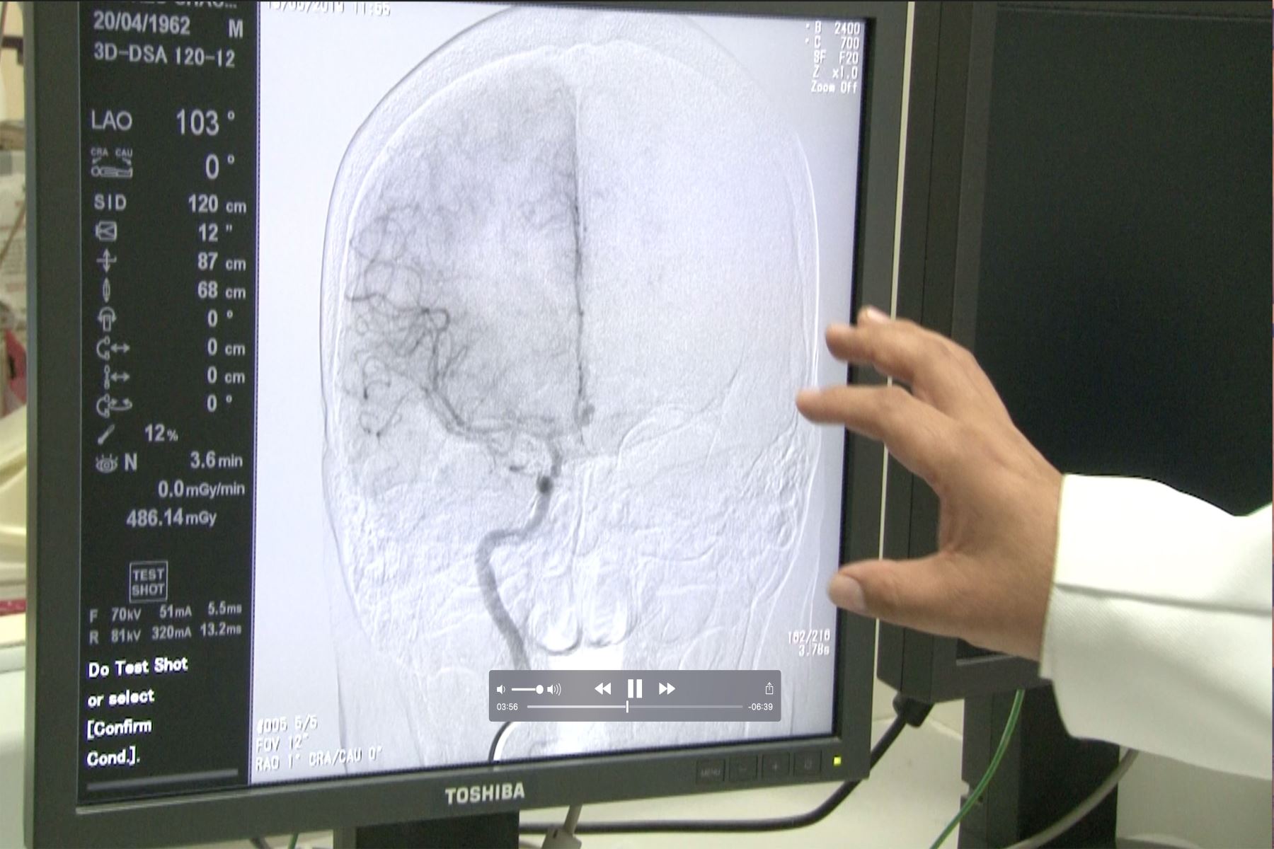 Procedimiento con moderno angiógrafo del hospital Carrión salvavidas de pacientes con problemas cerebrovasculares, foto: Andina/Difusión