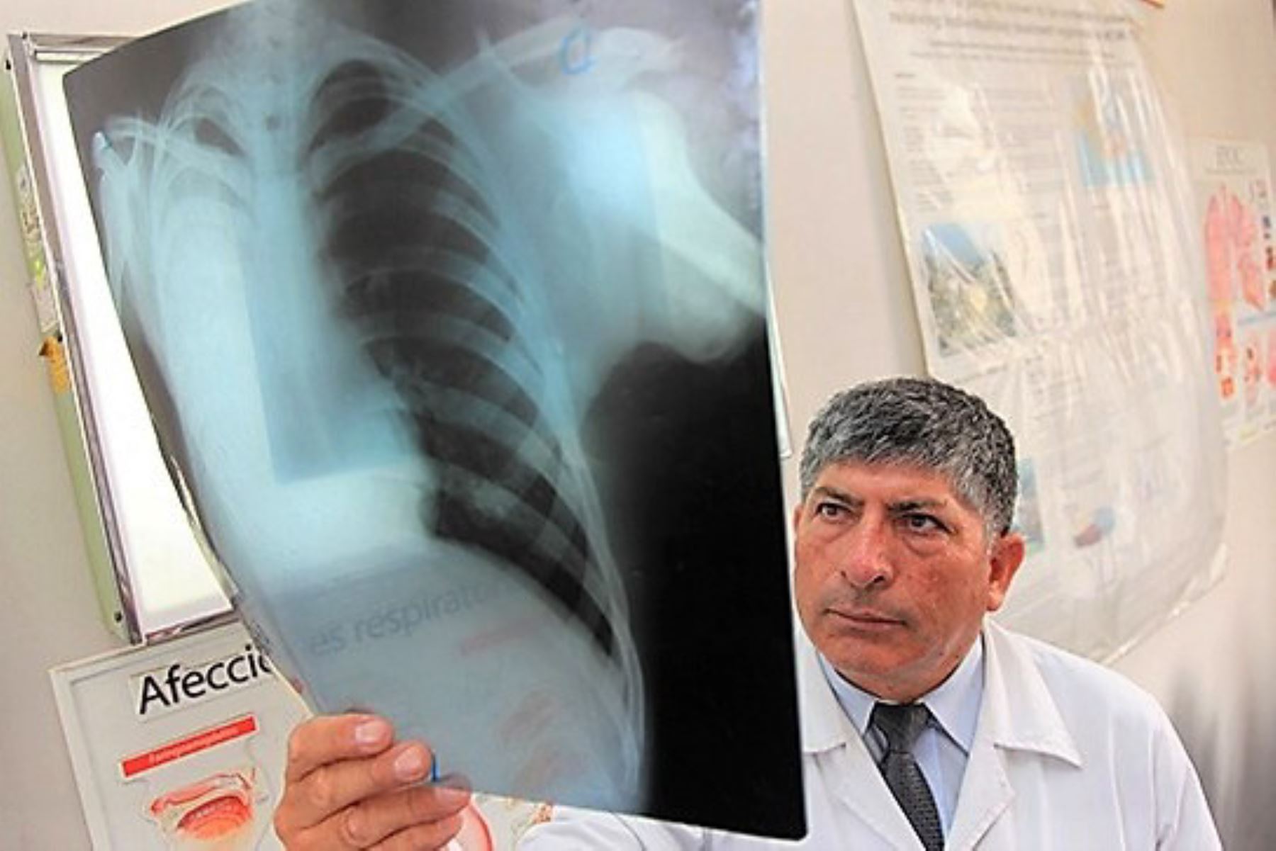 La fibrosis pulmonar es más frecuente entre personas con más de 50 años.