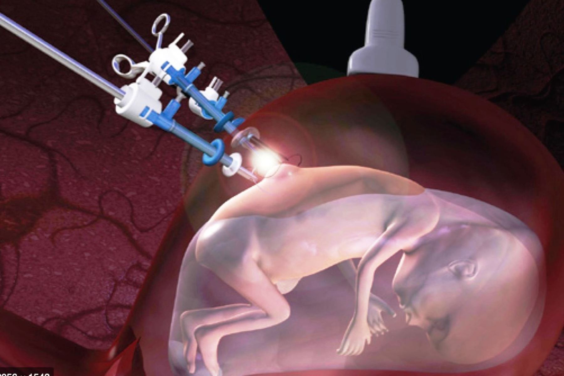 INMP realizó primera cirugía fetal de espina bífida sin corte. Foto: ANDINA/Difusión.