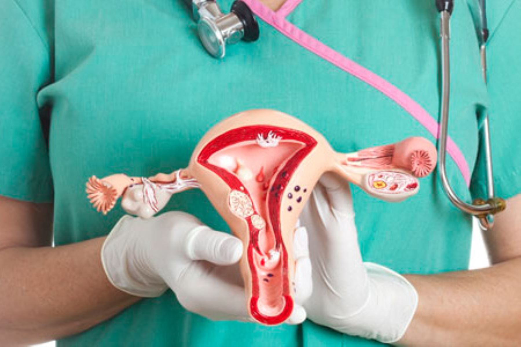 Los quistes hacen que la cáscara de los ovarios se haga más gruesa y que la mujer afectada tenga ciertas características andróginas o masculinizadas. Foto: Cortesía.