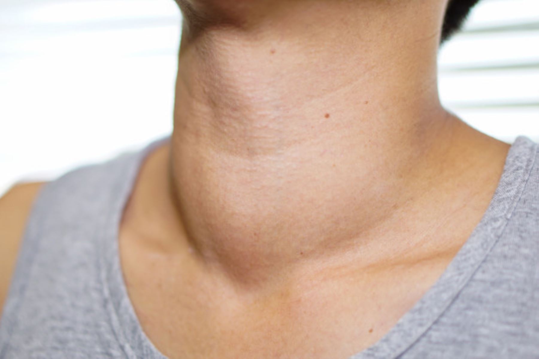 Un bulto en el cuello puede ser señal de cáncer de tiroides. Foto: Andina/Difusión