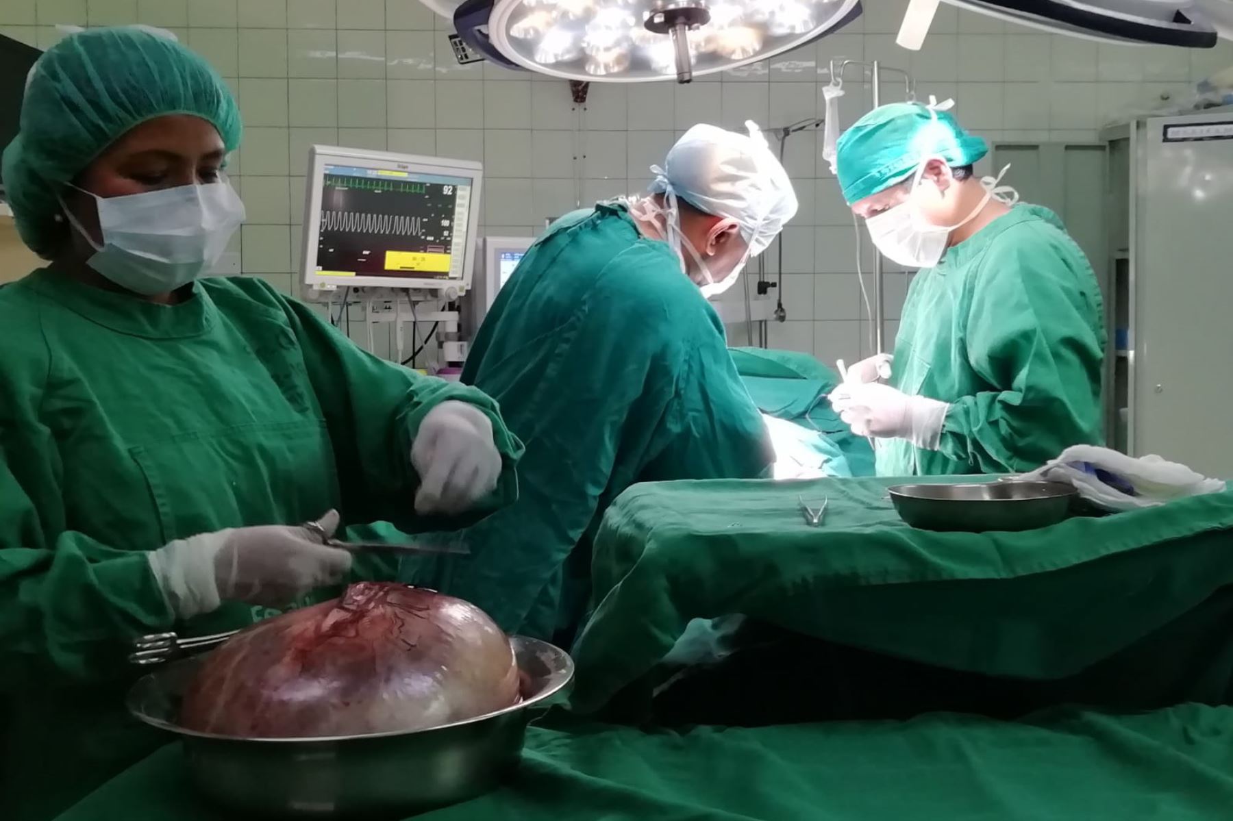 Un enorme tumor, que pesaba 4 kilos y medía 40 centímetros de largo, fue extirpado del vientre de una joven asegurada de 22 años de edad en una exitosa cirugía realizada por médicos del Hospital II de la Red Asistencial Huancavelica del Seguro Social de Salud (EsSalud).