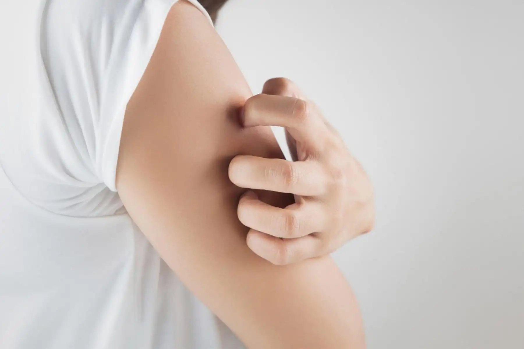 La neurodermatitis altera la condición de salud de la piel. Si la persona se rasca con fuerza provocará una alteración en ella como su engrosamiento, inflamación y hasta endurecimiento. ANDINA/Internet