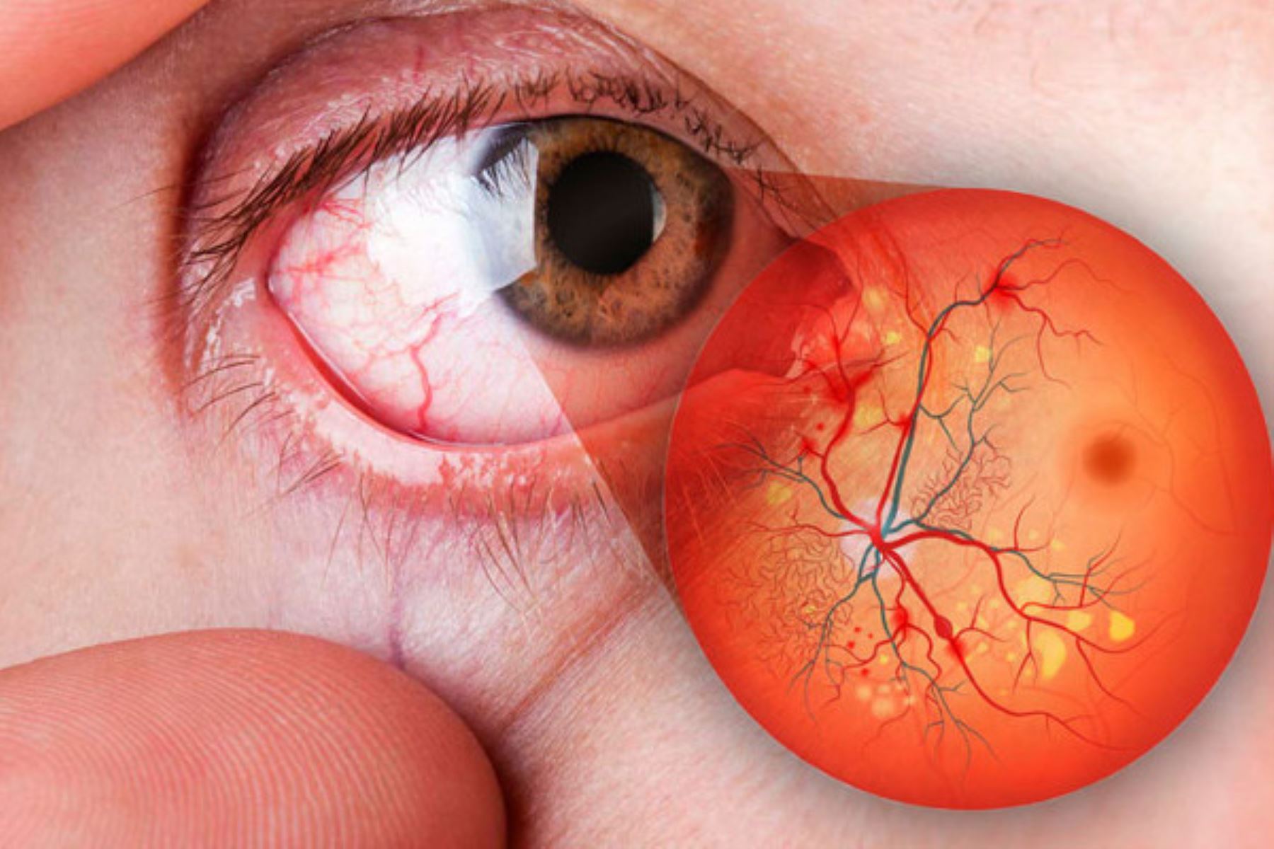 San Marcos: con inteligencia artificial detectarán la retinopatía diabética. Foto: ANDINA/Difusión.