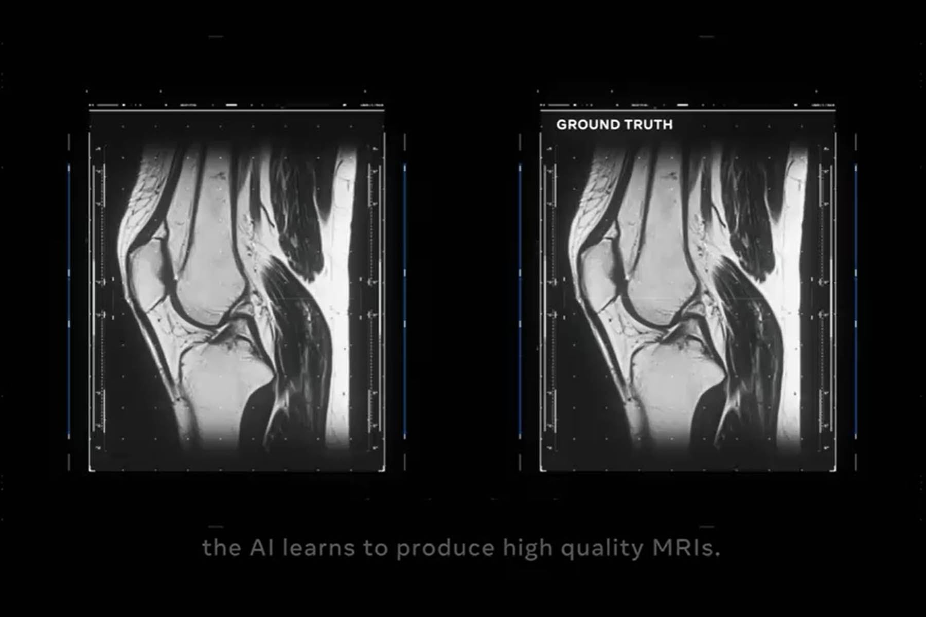 El estudio muestra que el fastMRI puede generar imágenes de resonancia magnética «equivalentes para el diagnóstico» de las lesiones de una rodilla al utilizar un 75% menos de datos sin procesar de la máquina de escaneo.