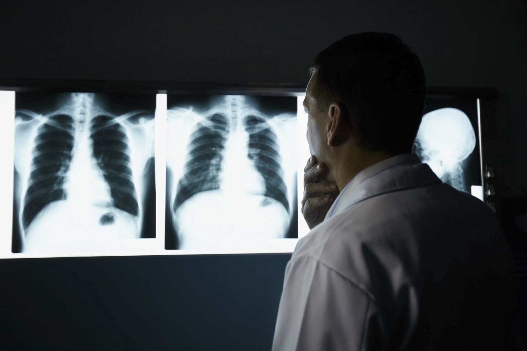 El cáncer de pulmón es la principal causa de muerte por cáncer en todo el mundo.  Foto. GTRES