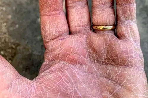 Esta mano pertenece a Salvatore Quarta, quien trabaja desde hace 16 años como anestesiólogo en el policlínico de La Scotte, en Siena, Italia. Foto: internet.