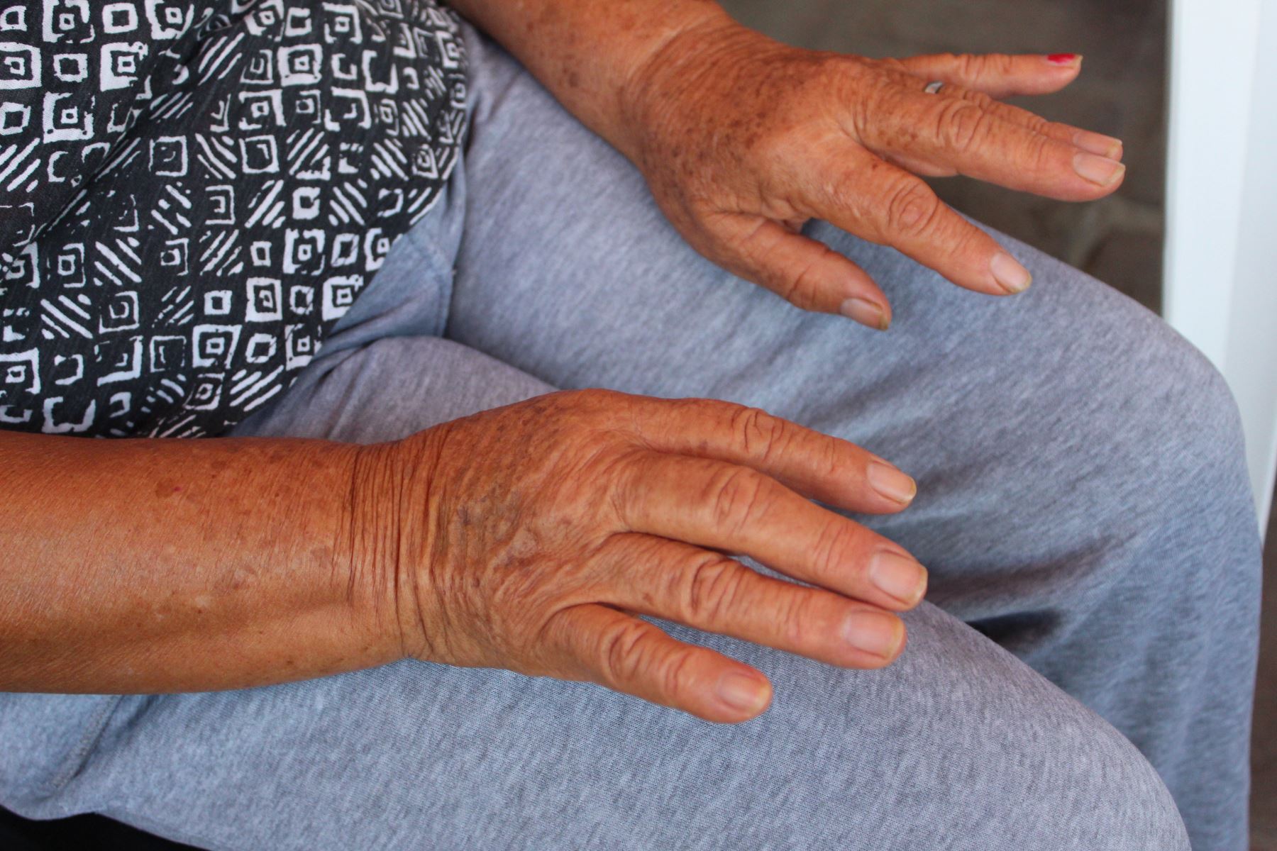 Parkinson puede comenzar con temblor de las manos en reposo. Foto: ANDINA/EsSalud