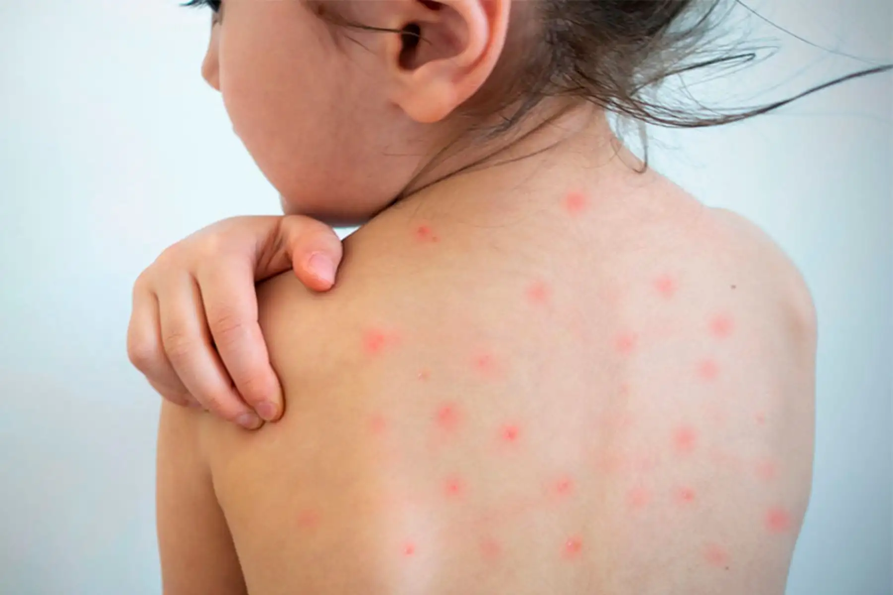 Gobierno declara emergencia sanitaria por polio y sarampión. Foto: Andina