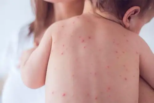 Es importante prevenir esta enfermedad mediante la vacunación que el Minsa ofrece de manera gratuita a los niños.