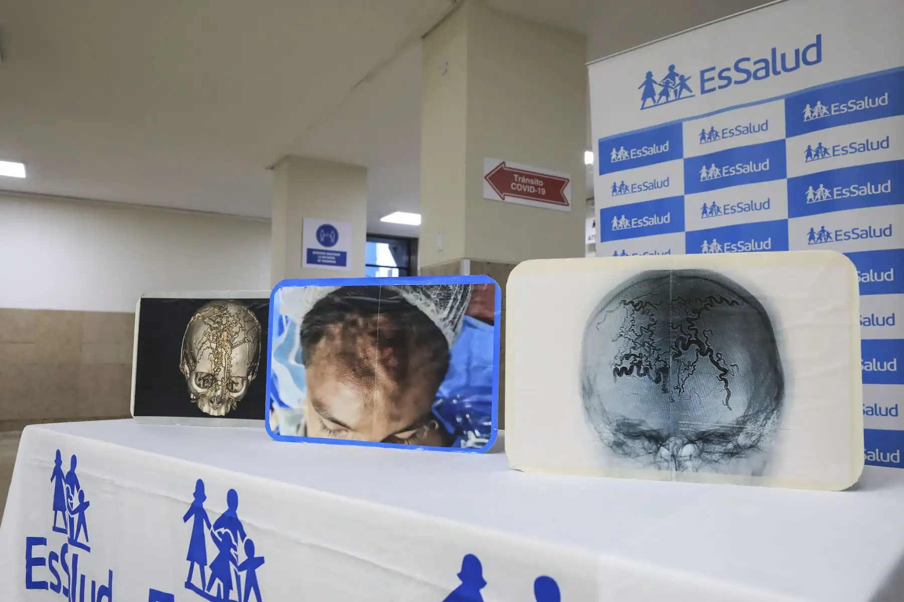 Hospital Almenara de EsSalud salva adolescente tras extirpar malformación vascular. Foto: EsSalud