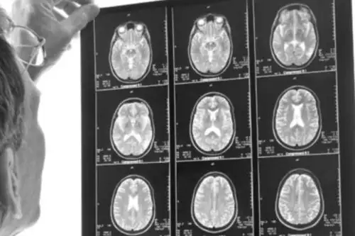 Entre los males  más frecuentes están el Alzaheimer, el Parkinson, así como la enfermedad de Huntington.