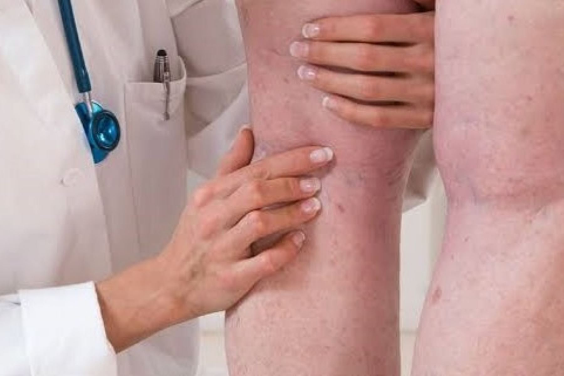 EsSalud: cerca del 10% de pacientes covid-19 sufrió trombosis en las piernas. Foto: ANDINA/Difusión.