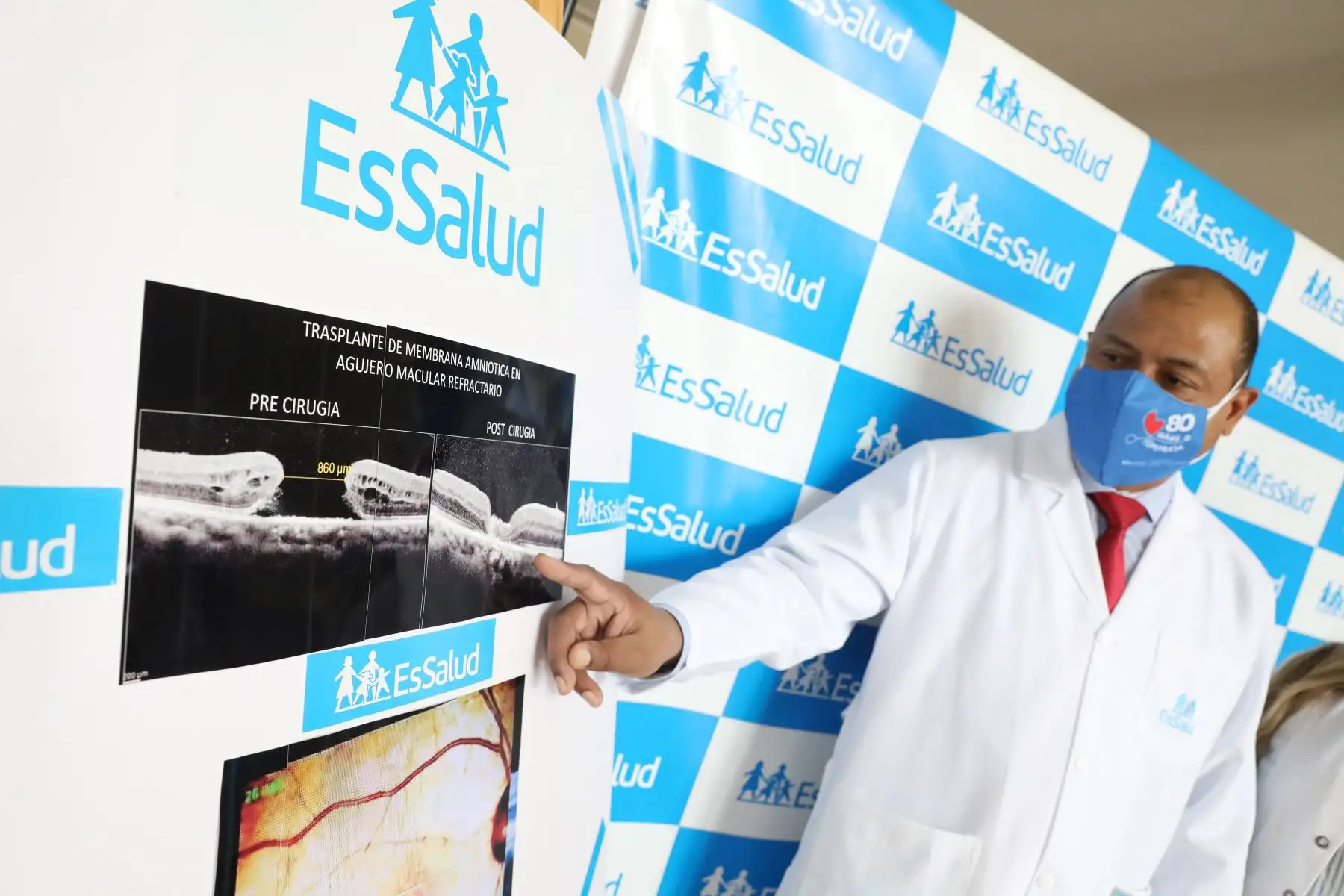 Especialistas del Hospital Almenara realizaron primer trasplante de membrana amniótica del ojo. La Innovadora cirugía logró que se regeneren los tejidos y la paciente Julia Lila Añorga Valverde, de 61 años, recupere la visión. Foto: ANDINA/Andrés Valle