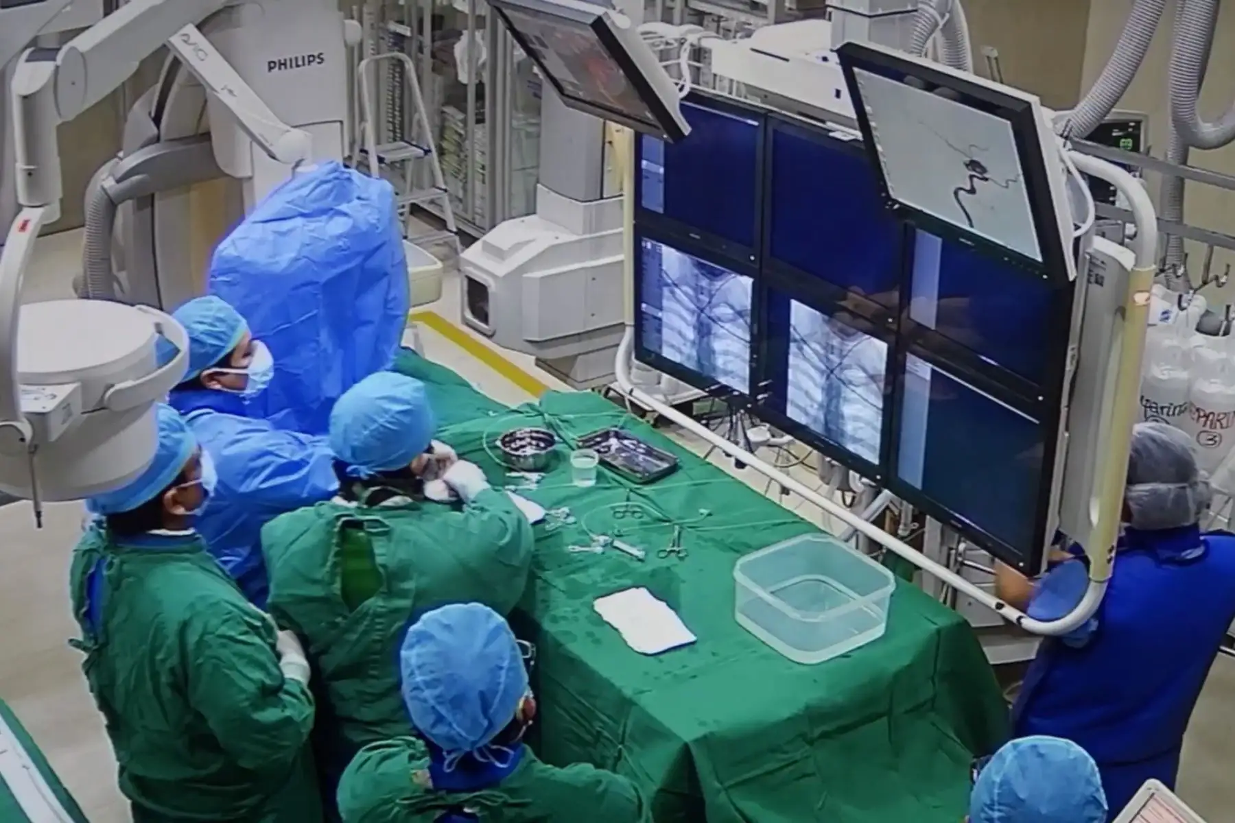 Médicos del hospital Almenara aplicaron por primera vez en EsSalud novedosa técnica quirúrgica de endoprótesis ramificada a asegurada de 48 años. Foto: EsSalud