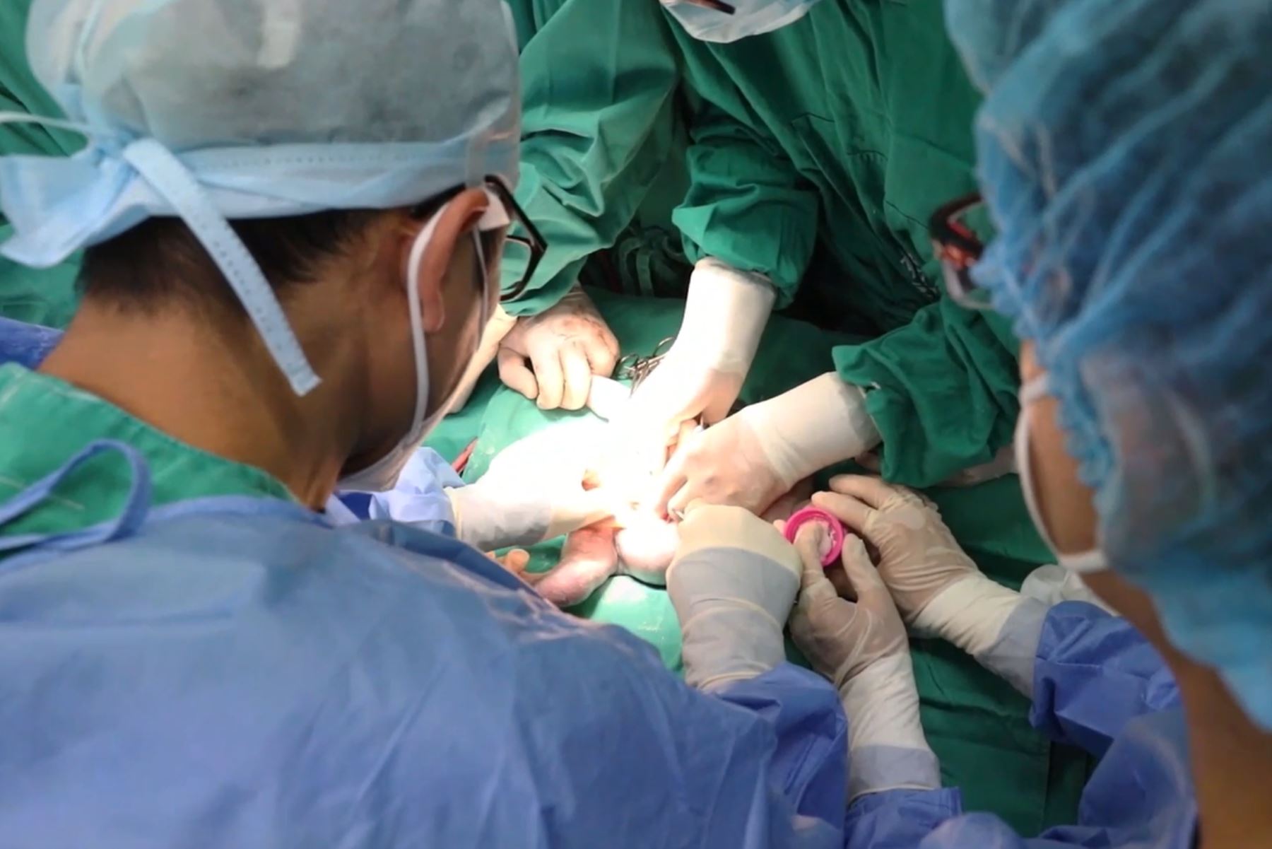 Especialistas de EsSalud intervinieron a recién nacido con una malformación conocida como “gastrosquisis”. Foto: ANDINA/Difusión