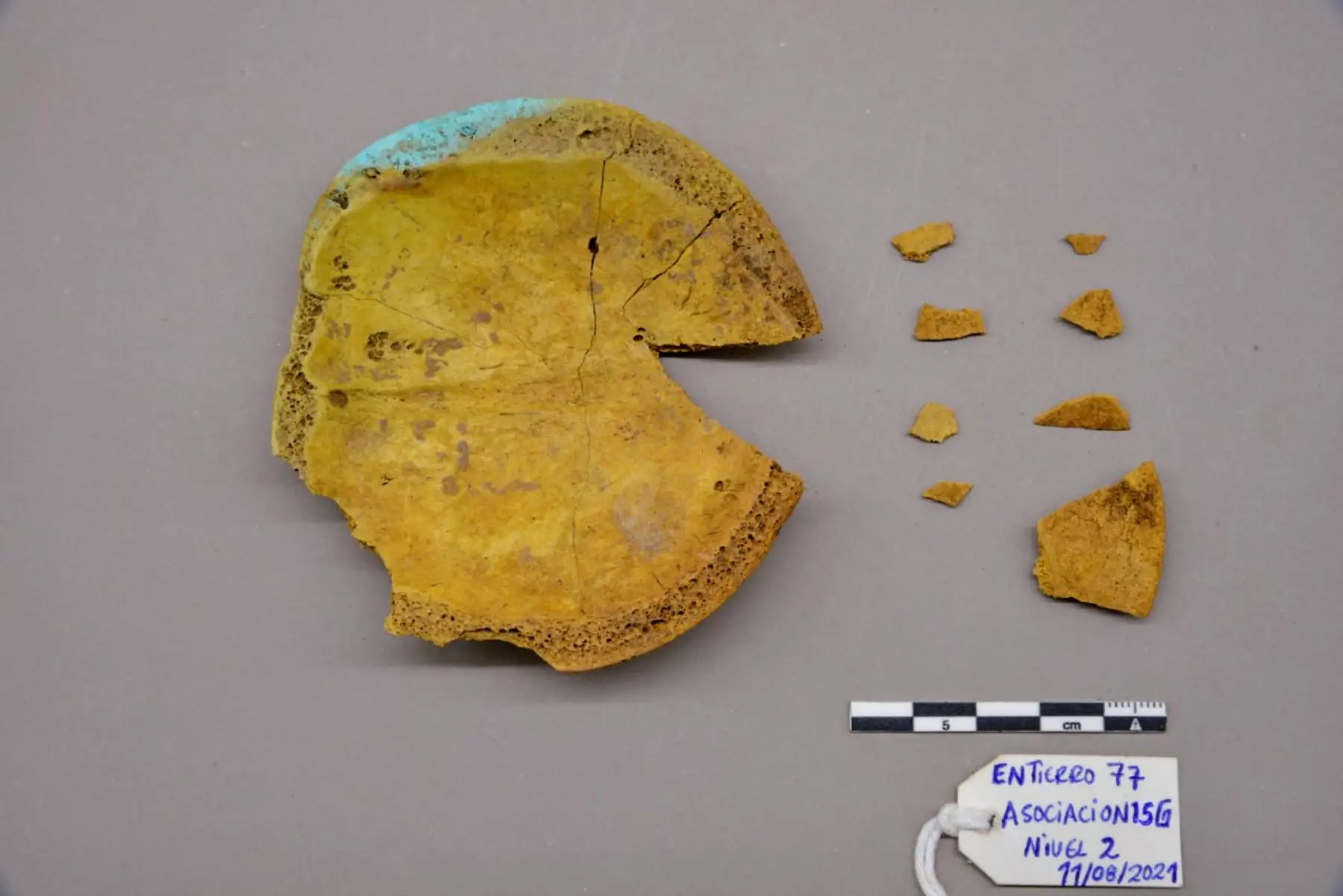 “Es el primer hallazgo de este tipo acá en Lambayeque y en el norte del país. Data del año 900 a 1050 después de Cristo, de afiliación cultural Sicán Medio, lo cual habla de la especialización y pericia que había en esta época. No solamente estamos documentando personajes de cultuea de élite ligados a la metalurgia sino también especialistas e intervenciones quirúrgicas”. Foto: Museo Nacional de Sicán