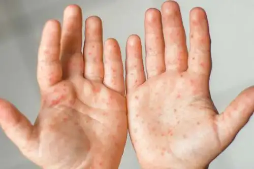 El síndrome es común en los niños y provoca fiebre, heridas en la boca, sarpullido en manos y pies. Foto: ANDINA/Difusión